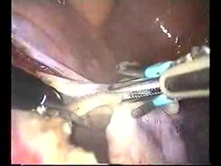 Laparoscopic Total Hysterectomy