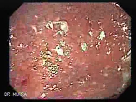 Ulcerative Colitis Complicating Colon Cancer (3 of 4)