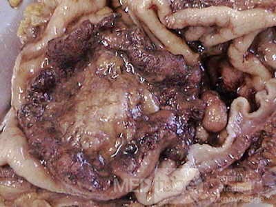 Rectal Adenocarcinoma that infiltrates the second and the 
 third valve (5 of 5)