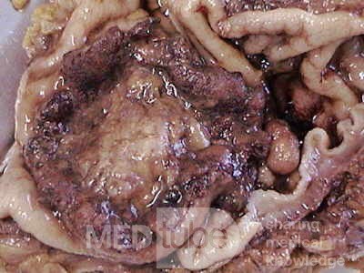 Rectal Adenocarcinoma that infiltrates the second and the 
 third valve (5 of 5)
