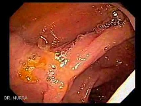 Giant Tubulo - Villous Adenoma (16 of 17)