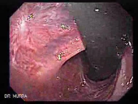 Long Standing Alcohol Abuse - Multiple Scars After Banding