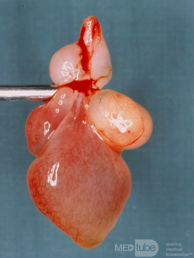 Nasal Polyp Removal With Powered Suction Shaver