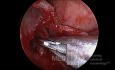 Right Frontal Dissection