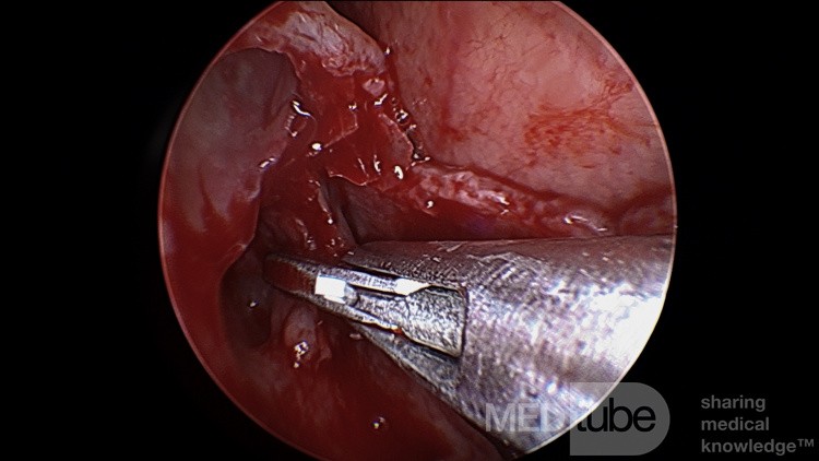 Right Frontal Dissection