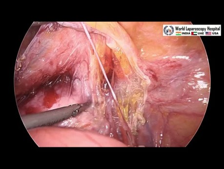 Skin to Skin Total Laparoscopic Hysterectomy Explained for Bulky Uterus