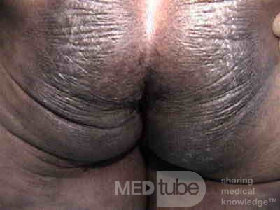 Extensive Acanthosis Nigricans due to rectal carcinoma (1 of 7)