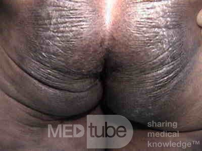 Extensive Acanthosis Nigricans due to rectal carcinoma (1 of 7)