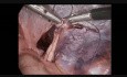 Laparoscopic Groin Hernia Repair, Step 10: Peritoneal Closure