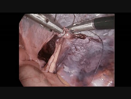Laparoscopic Groin Hernia Repair, Step 10: Peritoneal Closure