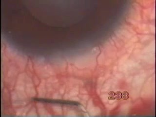 Glaucoma - operation with Fugo Blade