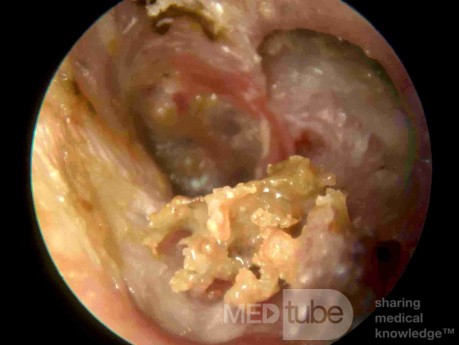 Sequestration in a Patient with Idiopathic Osteitis of the Tympanic Bone