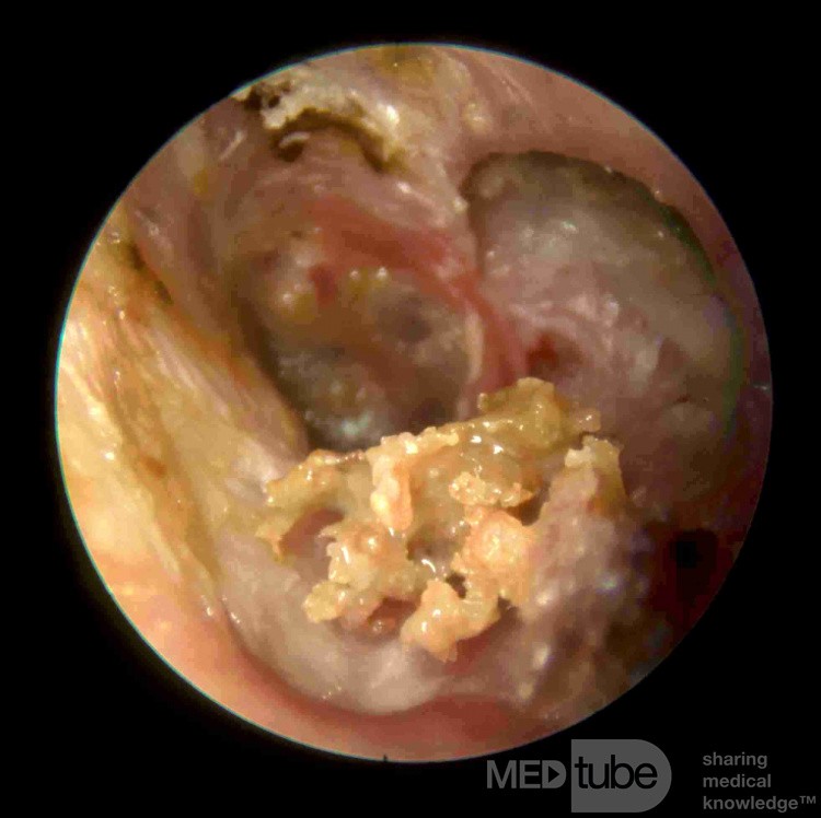 Sequestration in a Patient with Idiopathic Osteitis of the Tympanic Bone