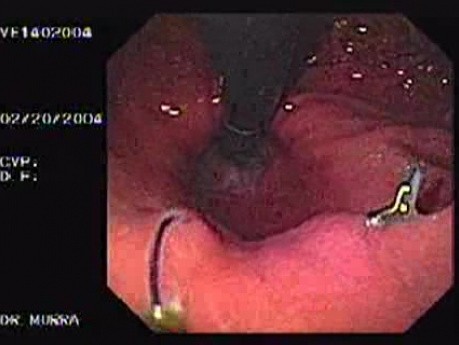 Intraluminal Endoscopic Suturing - Retroflexev View of Two Nodules, Part 1