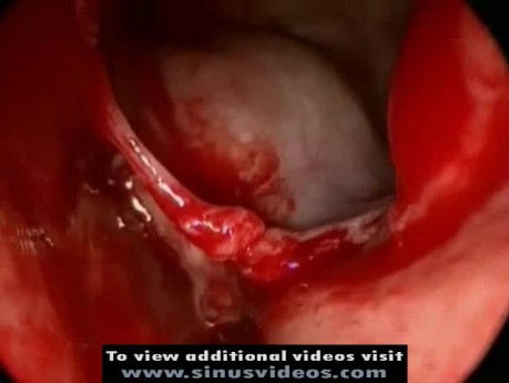 Endoscopic Removal Of Ethmoid Mucocele