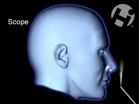 Nasal Sinus Surgery