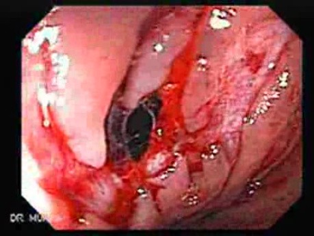 Consecutive colonoscopy with dilation was carried out (13 of 15)