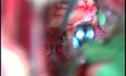 Clipping of an ACoA Aneurysm