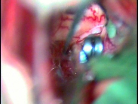 Clipping of an ACoA Aneurysm