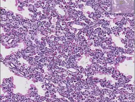 Hyaline membrane disease