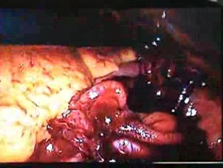 Jejunal Gastrointestinal Stromal tumor (GIST) (46of 86)