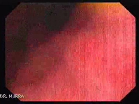 Esophageal Varices - Endoscopy (3 of 5)