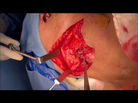 Submental Flap for Oral Cancer Reconstruction