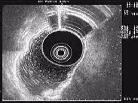Endoscopic Ultrasound (EUS) of Gastric Body (1 of 2)