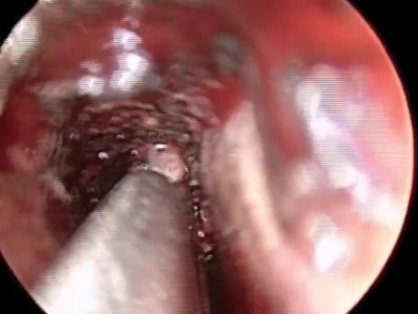 Acute Infection of Sphenoid Sinus Treated by Sphenoidotomy