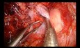 Uniportal VATS Intrapericardial Bilobectomy with Superior Cava Vein Partial Resection