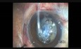 Anterior Capsulotomy in a Case of Fibrosed Anterior Capsule