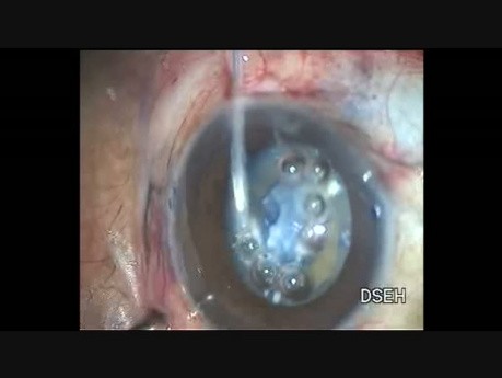 Anterior Capsulotomy in a Case of Fibrosed Anterior Capsule