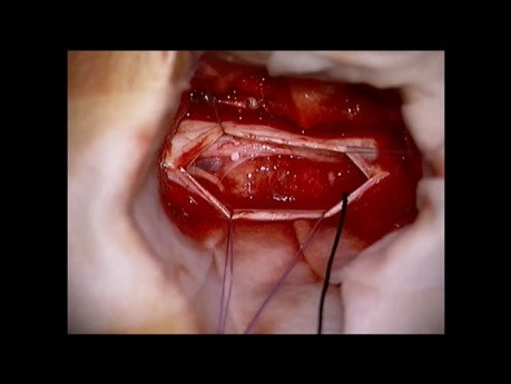 Spinal Tumors