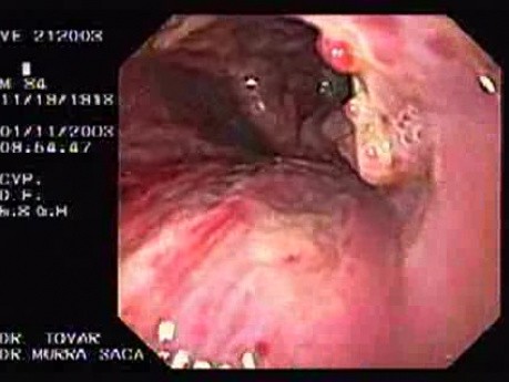 Laryngeal carcinoma invading epiglottis and tongue 1/2