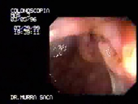 Histoplasmosis of the Colon (2 of 3)