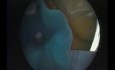 Hypoplastic Maxillary Sinus Type 2 - Endoscopic Drainage