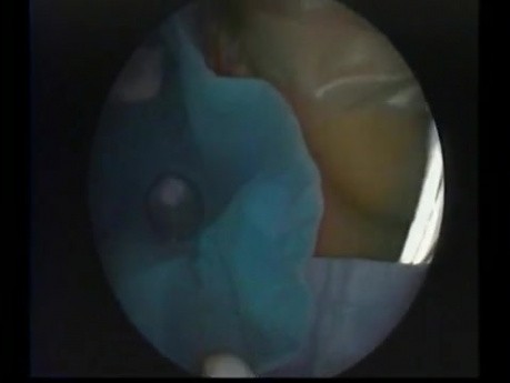 Hypoplastic Maxillary Sinus Type 2 - Endoscopic Drainage