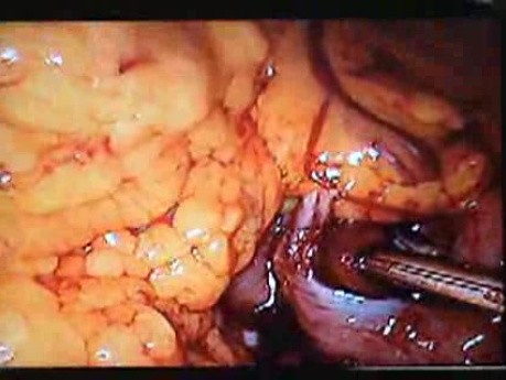 Jejunal Gastrointestinal Stromal tumor (GIST) (44 of 86)
