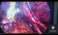 Deep Endometriosis Excision with Peritonectomy and Retrocervical Nodule Resection