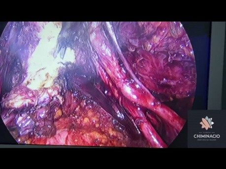 Deep Endometriosis Excision with Peritonectomy and Retrocervical Nodule Resection
