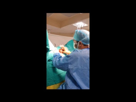 Ano Scrotal Fistula