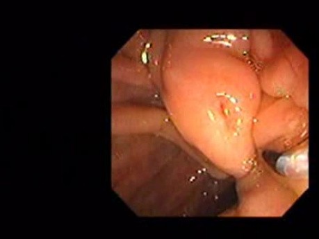 Adenocarcinoma of the Pancreas (5 of 8)
