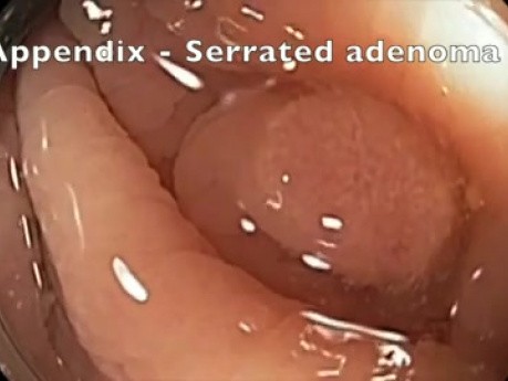Appendix - Flat lesion - EMR
