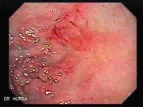 Duodenal Ulcer (4 of 4)