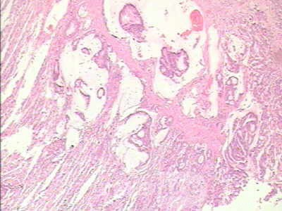 Adenocarcinoma of the cardias and gastric fundus with signet-ring cells (20 of 25)