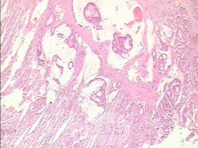 Adenocarcinoma of the cardias and gastric fundus with signet-ring cells (20 of 25)