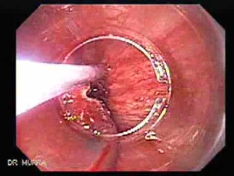 Mucosectomy as a Treatment for Early Gastric Cancer, Part 3