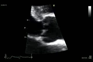Acute Aortic Regurgitation