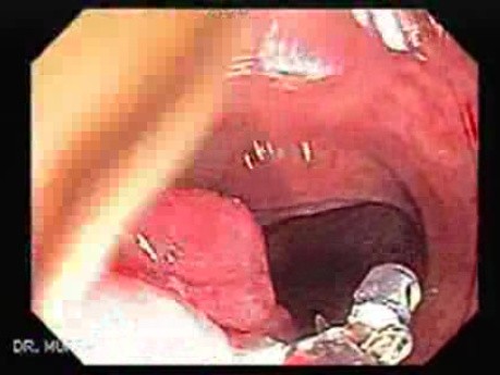 Huge Mass Of The Descending Colon (1 of 25)