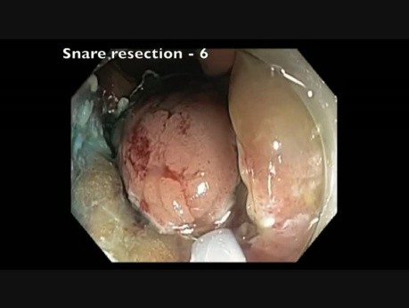 Colonoscopy Channel - EMR Of A Large Flat Lesion In The Ascending Colon